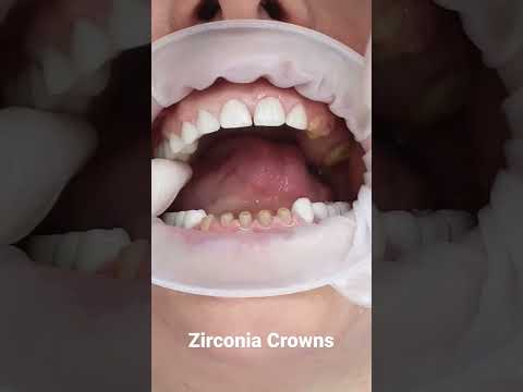 Single zirconia crowns #zirconia #zirconiacrown #dentist #teethtalk